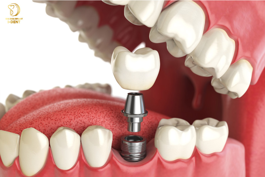 Nếu đủ điều kiện thì có thể cấy trụ Implant ngay sau khi nâng xoang