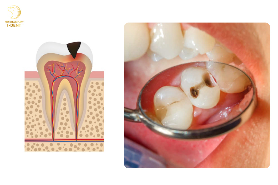 Sâu răng độ 2 (Sâu răng đã ăn vào tuỷ)