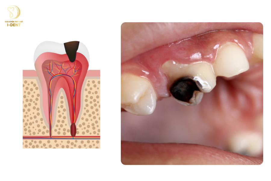 Sâu răng độ 3 ( Sâu đến tủy răng)