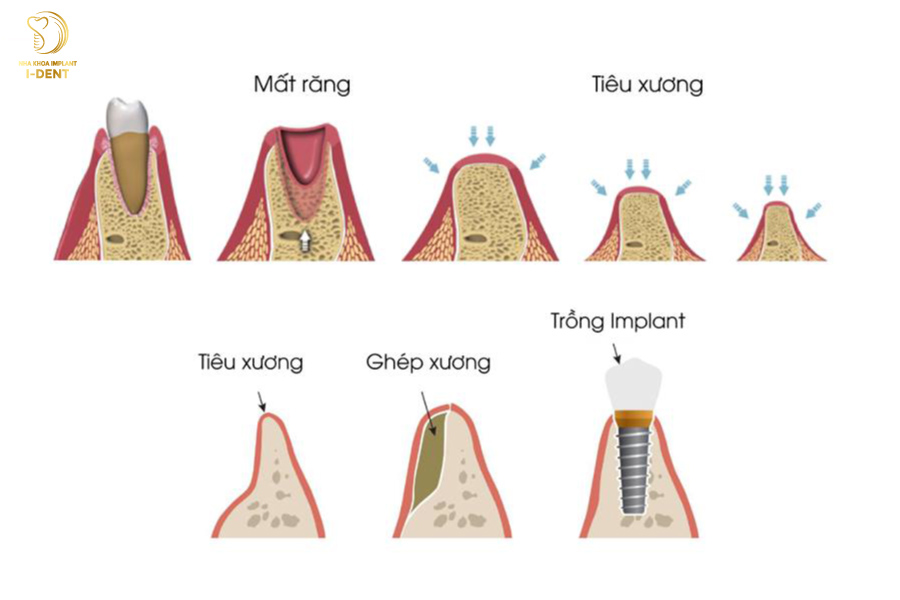 Trồng răng Implant giúp ngăn chặn tiêu xương hàm