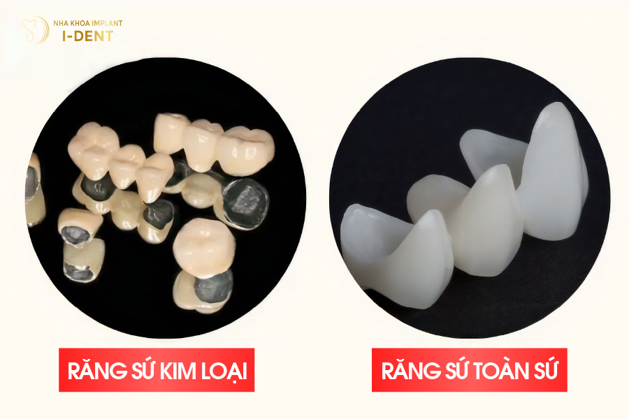 Răng sứ kim loại và răng toàn sứ