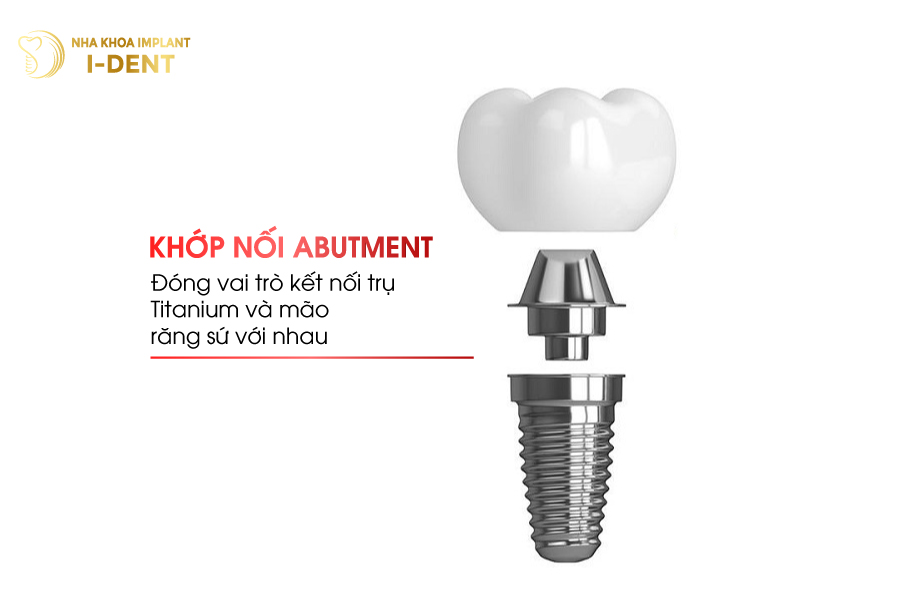 Abutment Implant giúp kết nối trụ và răng sứ