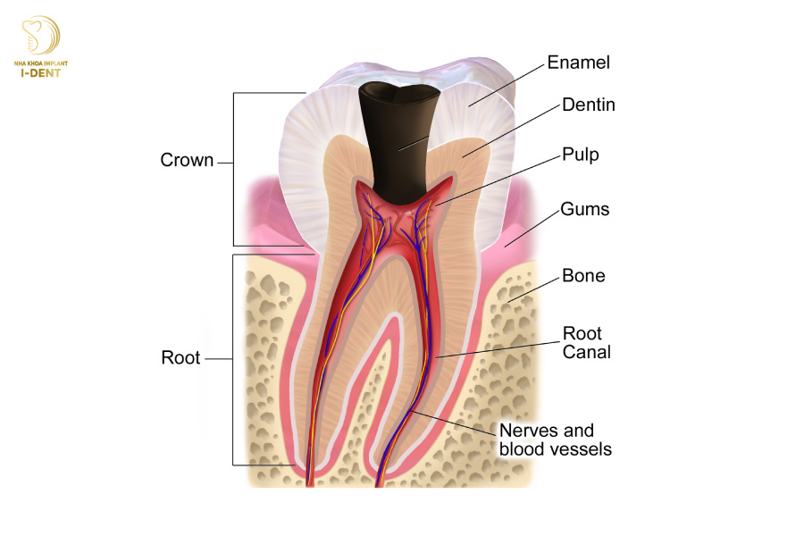 Răng bị viêm tủy