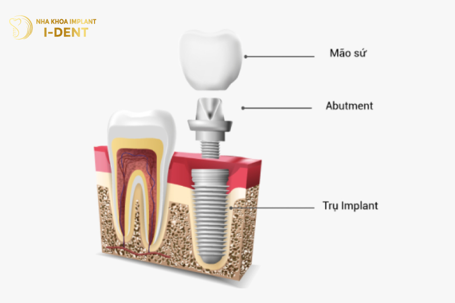 Cấu tạo trụ Implant