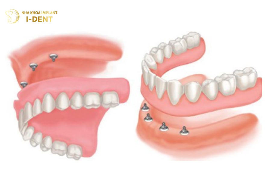 Hàm phủ trên Implant sau khi hoàn thiện