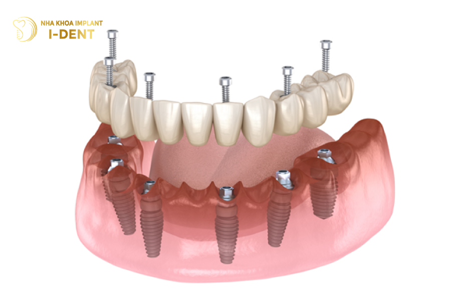 Implant Nobel phục hình cứng chắc khi cấy ghép toàn hàm All On