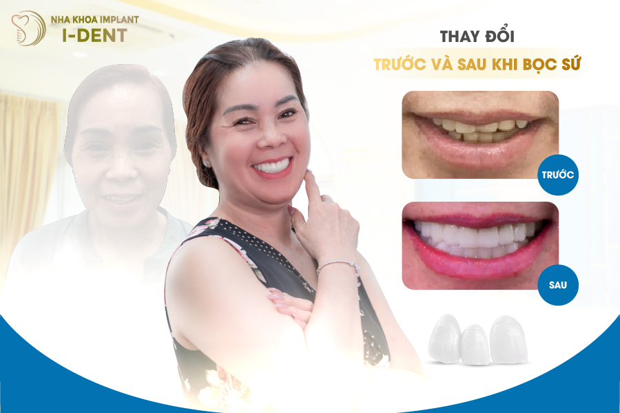 khách hàng sau khi bọc răng sứ tại Nha khoa I-DENT