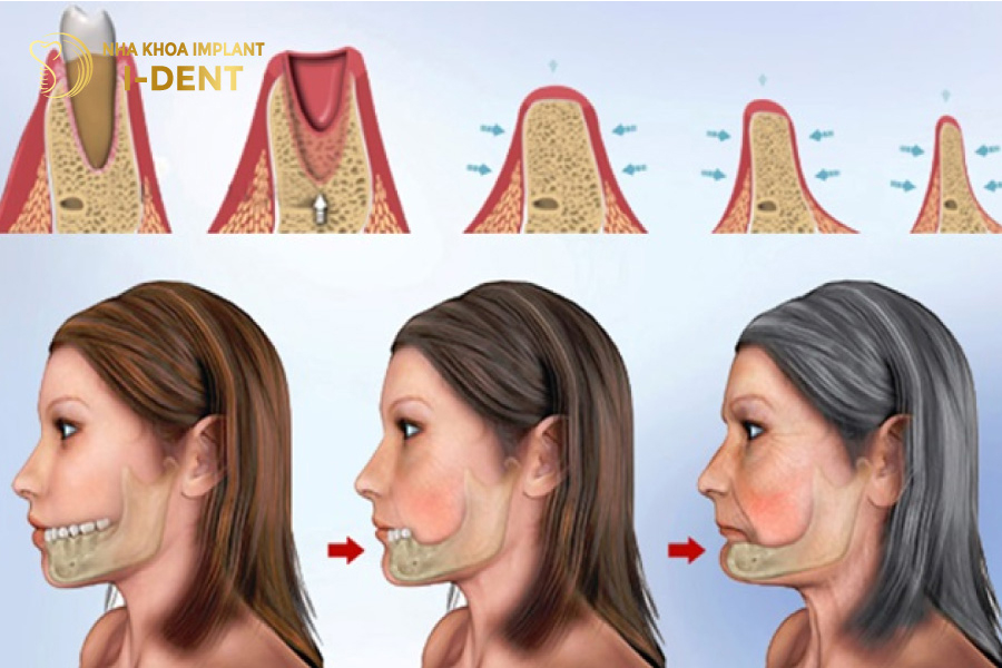 Những trường hợp xương hàm mỏng, tiêu xương nhiều không nên cấy trụ Kontact