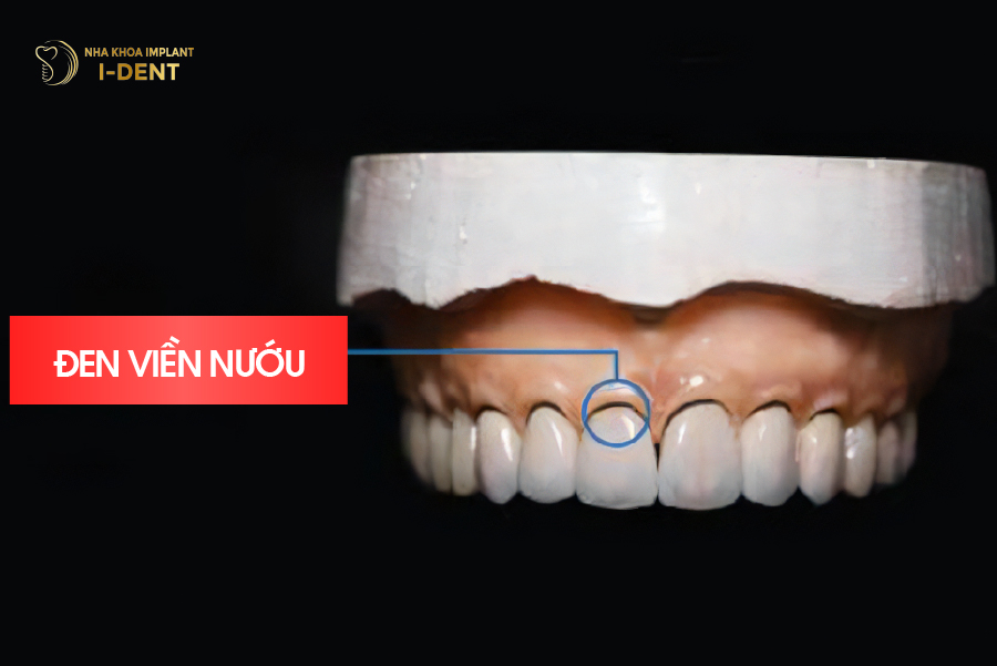 Viền nướu bị đen do sử dụng răng sứ Titan