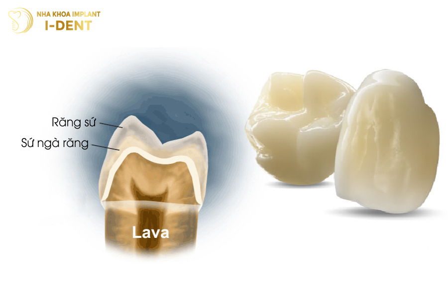 Răng sứ Lava