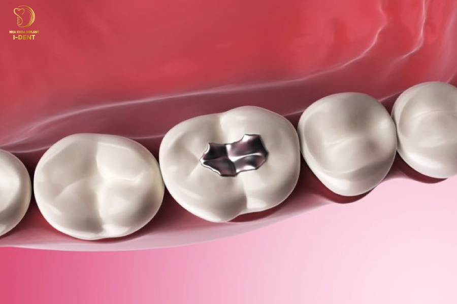 Trám răng bằng Amalgam 