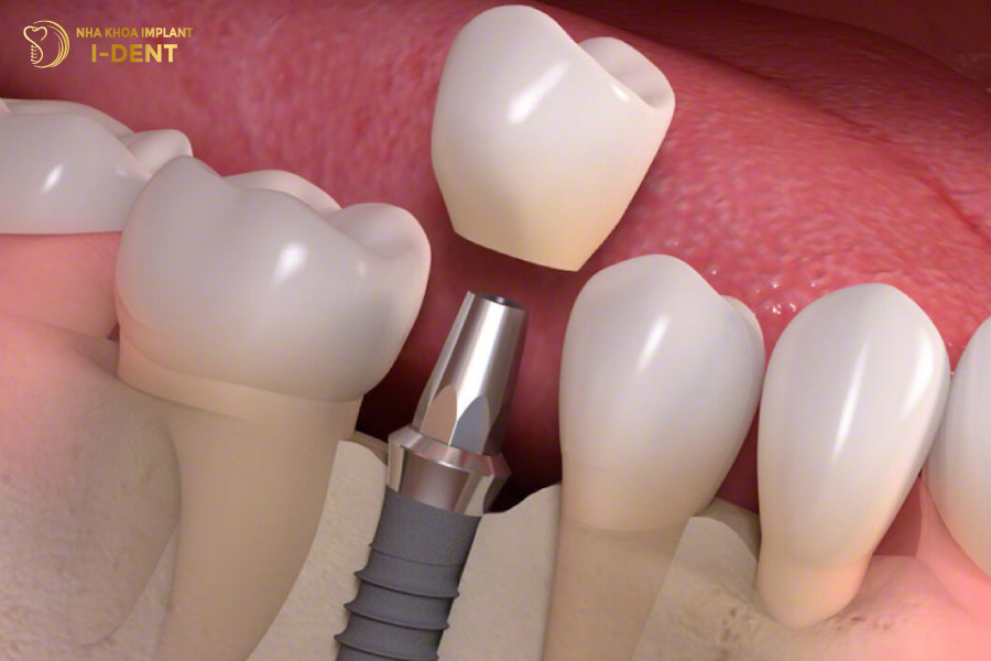 Trồng Implant khi không còn chân răng