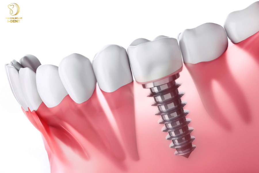 Làm răng giả nguyên hàm bằng phương pháp trồng răng Implant