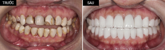 Khách hàng bọc răng sứ toàn hàm với màu răng om1