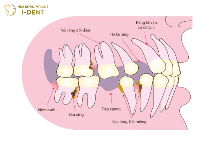 Bệnh lý răng miệng không điều trị dứt điểm sẽ gây hại đến răng sứ lẫn răng thật