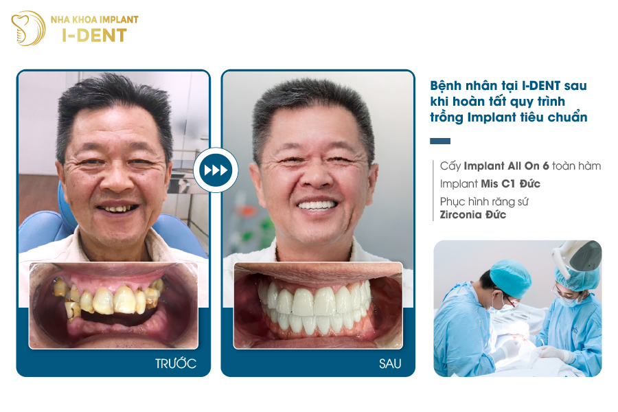 Bệnh nhân tại I-DENT sau khi hoàn tất quy trình trồng Implant tiêu chuẩn