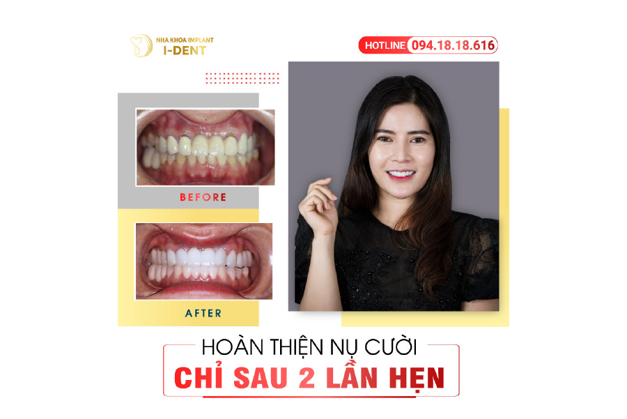 Bọc răng sứ giúp cải thiện thẩm mỹ cho răng một cách tự nhiên nhất