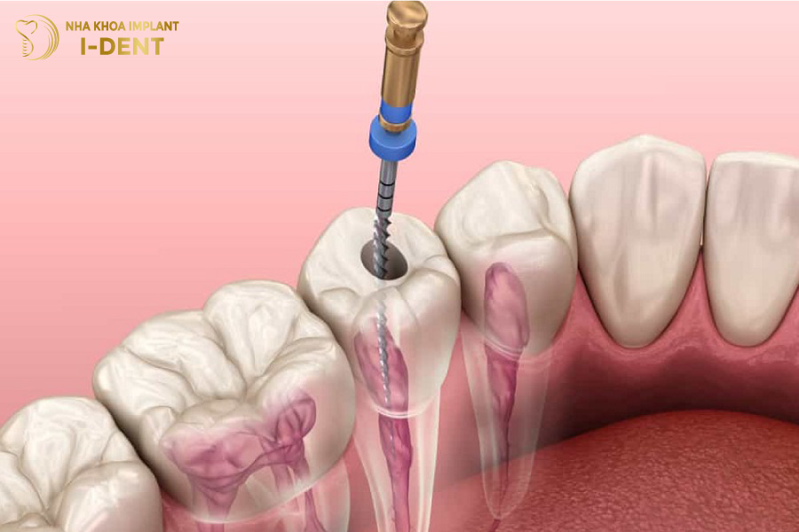 Bọc răng sứ sau khi lấy tủy có đau không