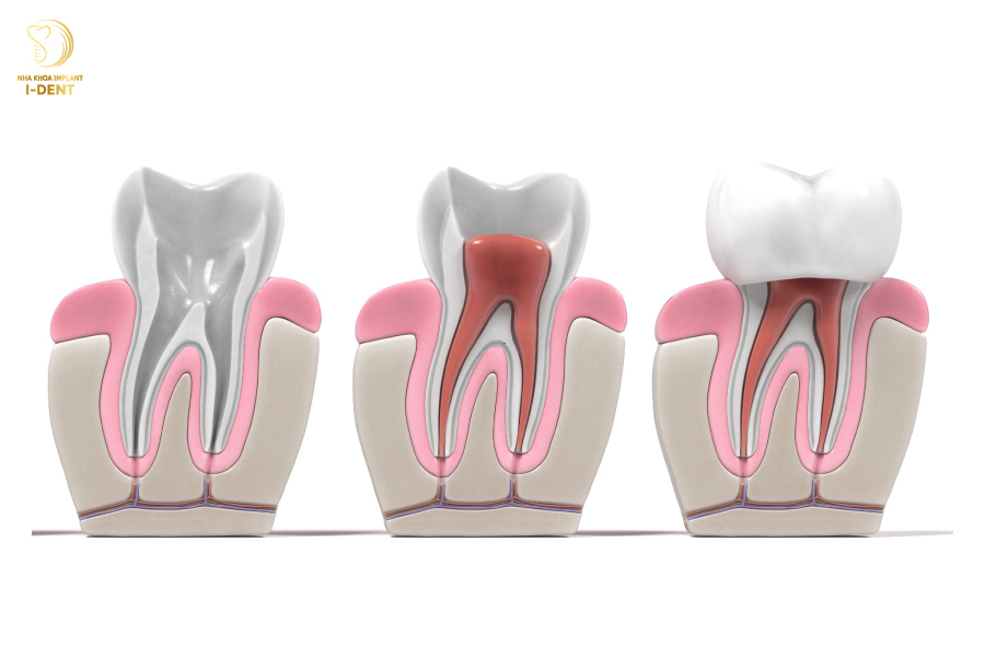 Bọc sứ răng sâu là cách bảo tồn răng thật tốt nhất