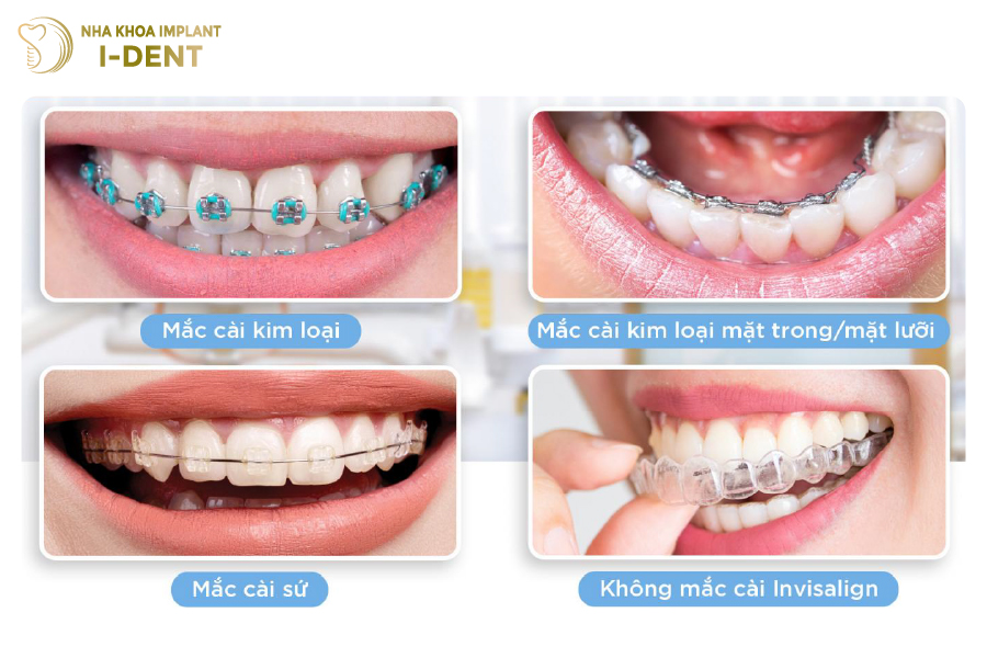 Các phương pháp niềng răng phổ biến hiện nay