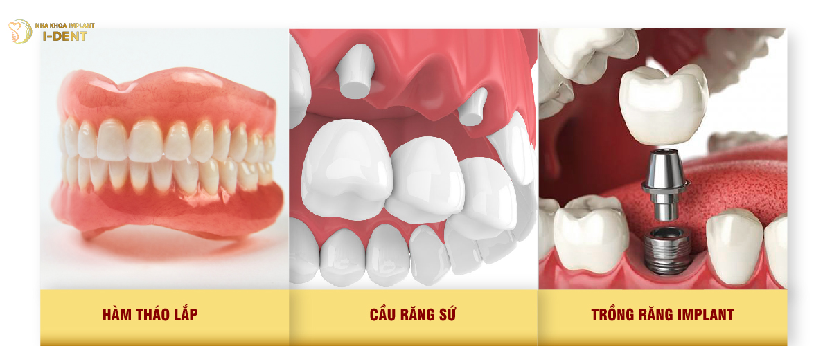 Trồng răng giả mất bao lâu? - Các phương pháp trồng răng giả hiện nay