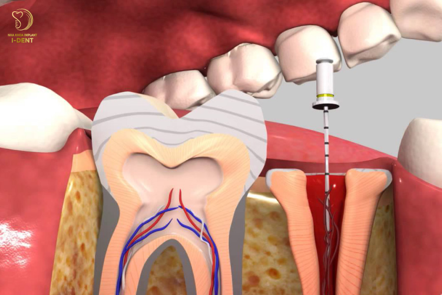 Viêm tủy sau bọc sứ khiến bạn tốn kém thời gian và tiền bạc để điều trị lại từ đầu