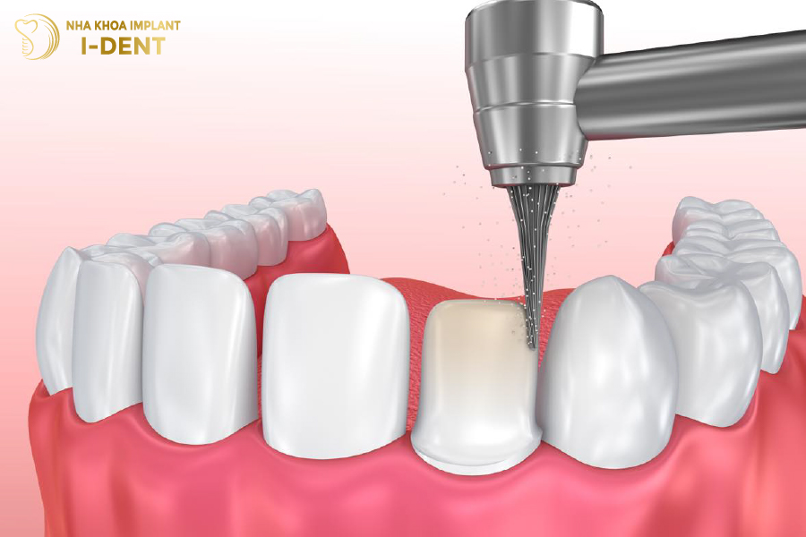 Bác sĩ mài răng quá nhiều sẽ khiến răng bị tổn thương và đau nhức 