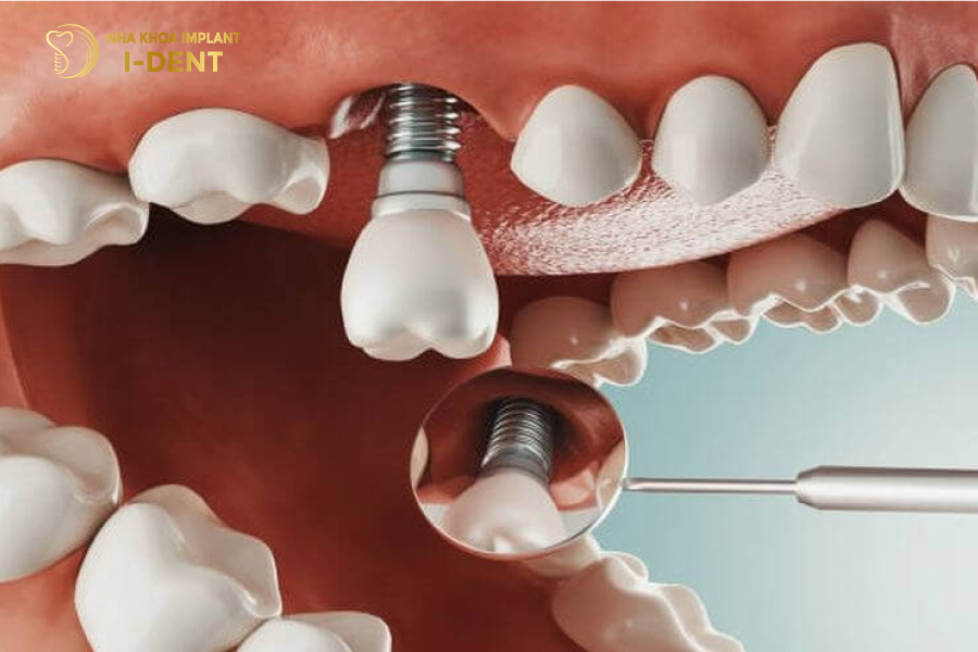 Cẩn thận Implant Straumann giá rẻ, kém chất lượng