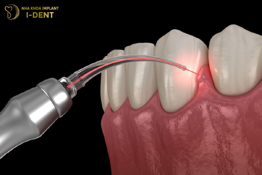 Cắt lợi và làm sạch ổ viêm để khắc phục tình trạng nhiễm trùng răng sứ