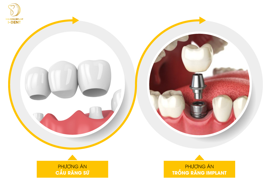 phương án trồng răng Implant và bắc cầu sứ.