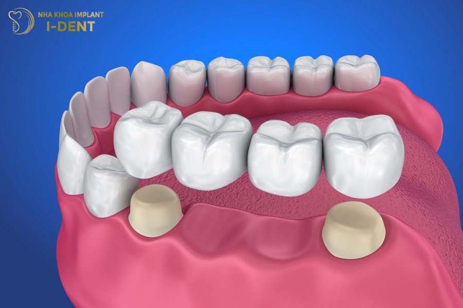 Cầu răng sứ được chỉ định khi không đủ điều kiện sức khỏe để trồng răng Implant