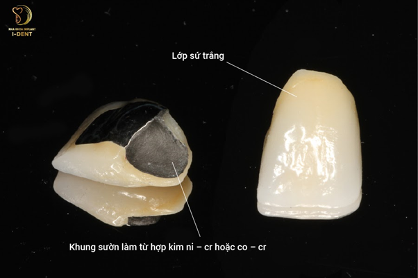 Cấu tạo của răng sứ kim loại thường