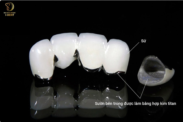 Cấu tạo của răng sứ kim loại Titan