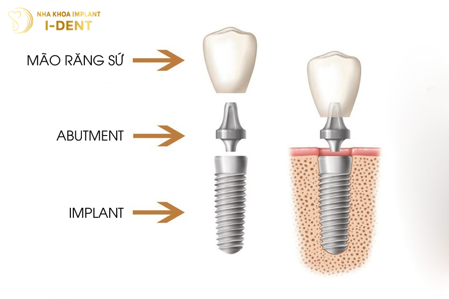 Hình ảnh cấu tạo trụ Implant