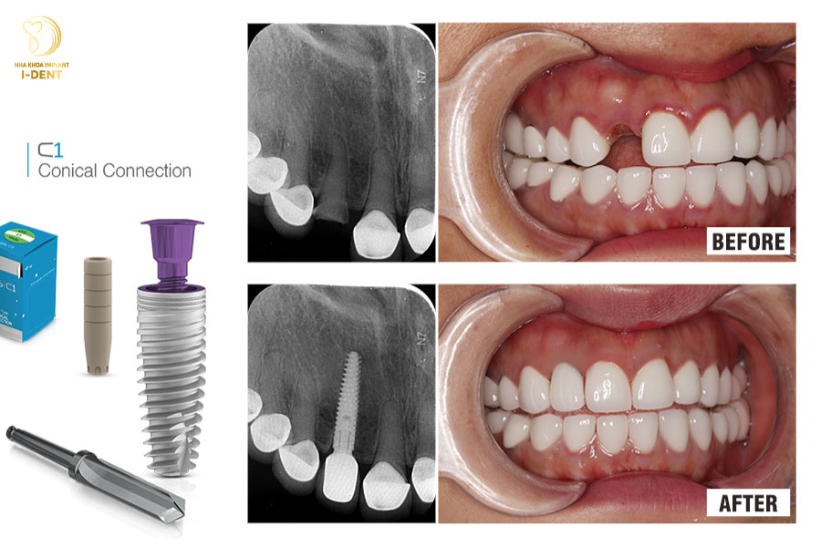 Cấy ghép Implant có thể khắc phục được tình trạng tiêu xương