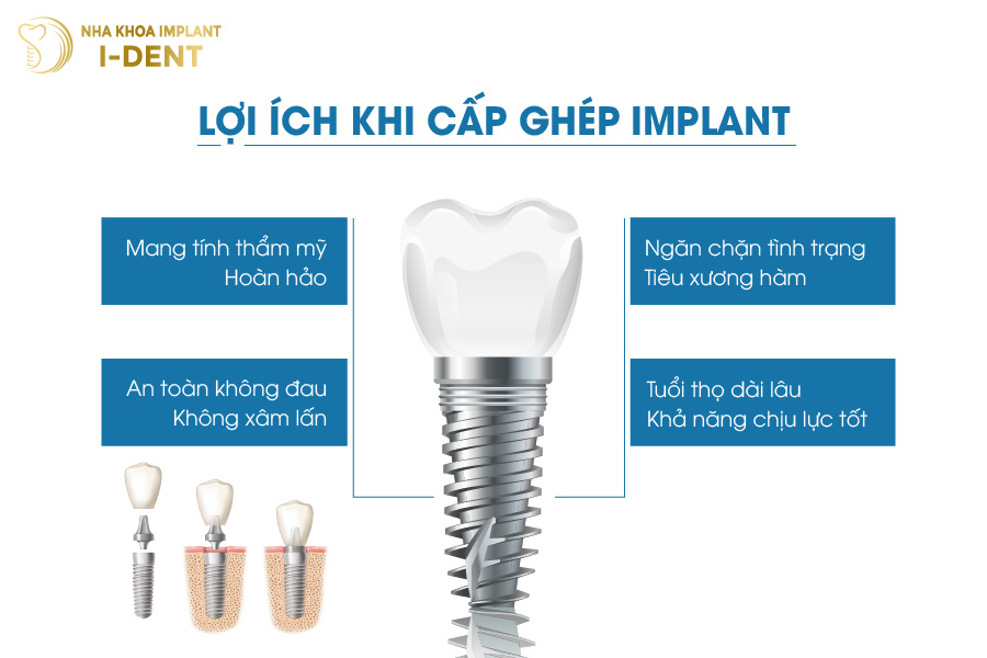 Cấy ghép Implant mang lại nhiều lợi ích cho bệnh nhân mất răng