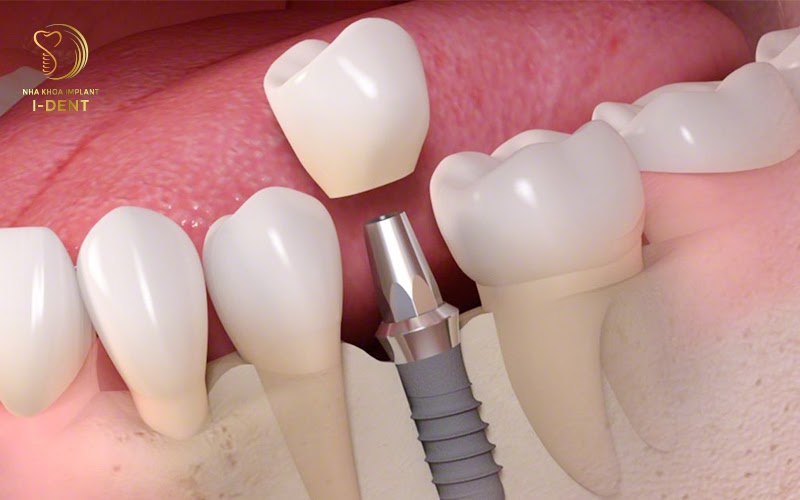 Trồng răng Implant dược nhiều người ưa chuộng