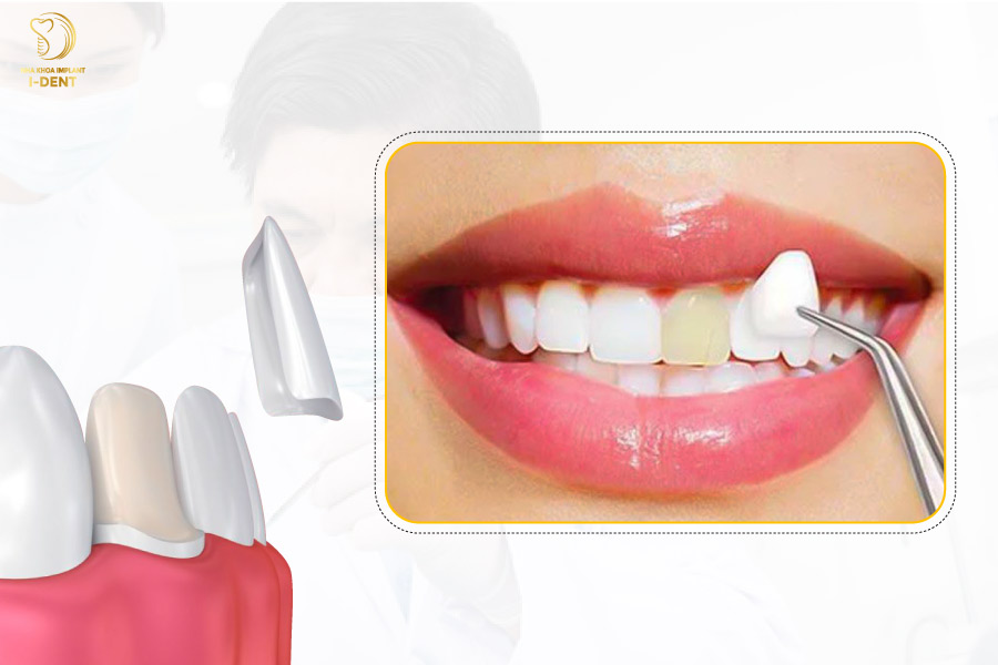 Dán sứ Veneer tại Nha khoa I-DENT 