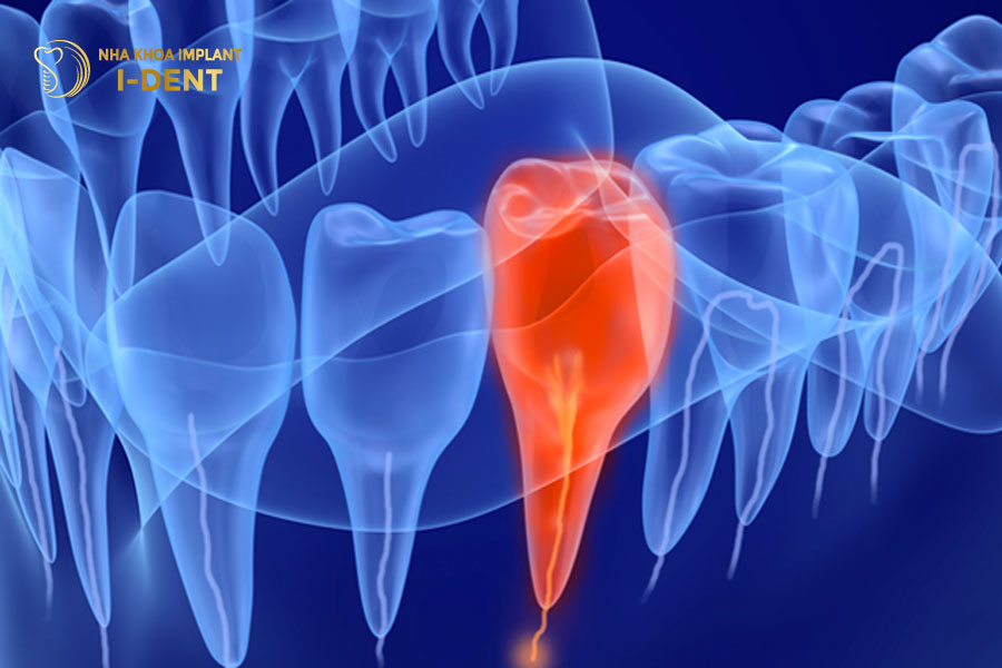 Dấu hiệu nhận biết răng chết tủy