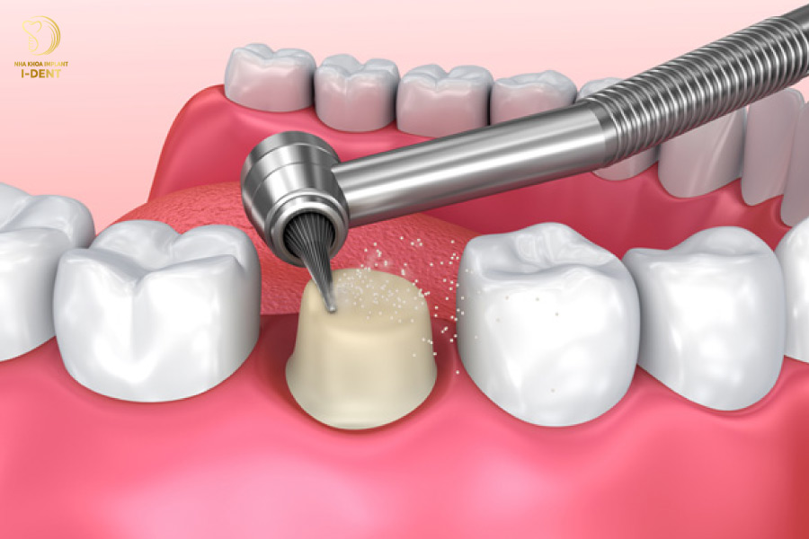 Để làm cầu răng sứ, bác sĩ bắt buộc phải mài răng