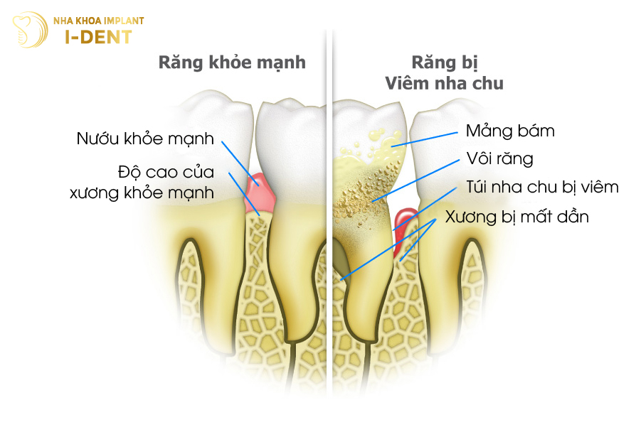 Các bệnh lý về bệnh nha chu