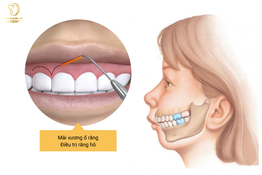 Mài xương ổ răng điều trị răng hô