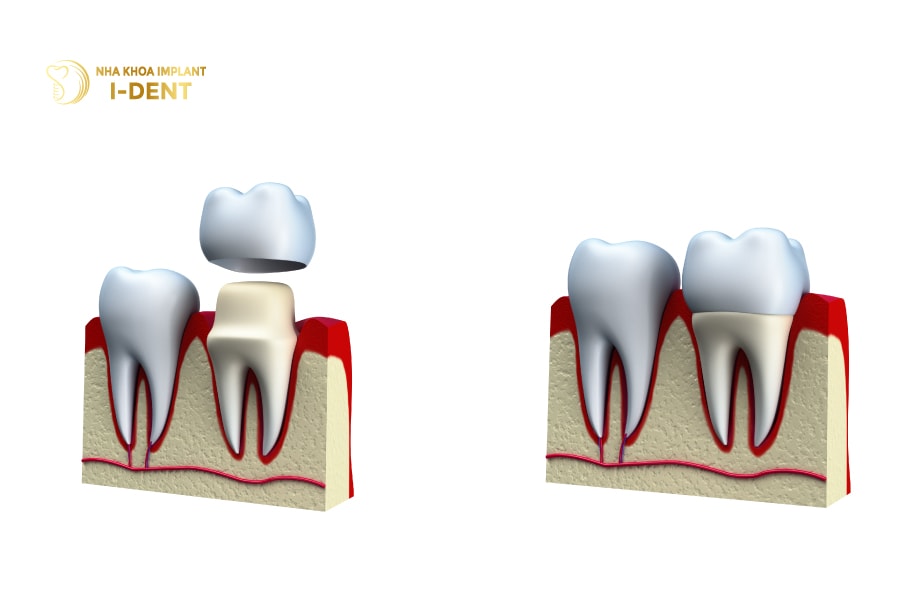 Gắn răng sứ Zirconia Ceramill Zolid 