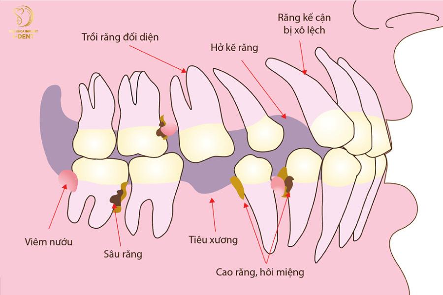 Gãy răng làm tăng nguy cơ sâu răng và các bệnh lý khác, thậm chí là mất răng