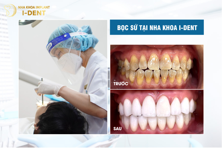 Giá răng sứ DDBio tại các nha khoa uy tín sẽ không chênh lệch quá nhiều