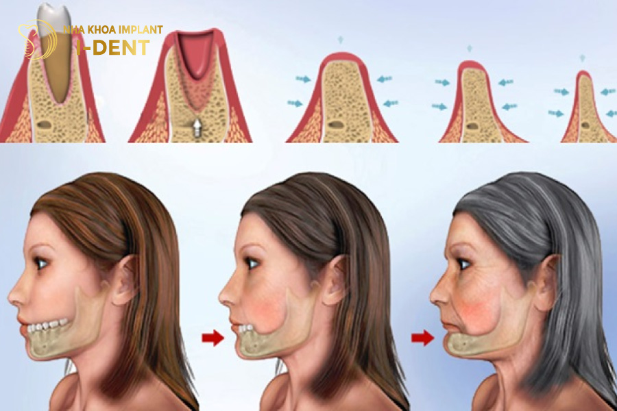 Không trồng răng sớm sẽ có tình trạng tiêu xương hàm