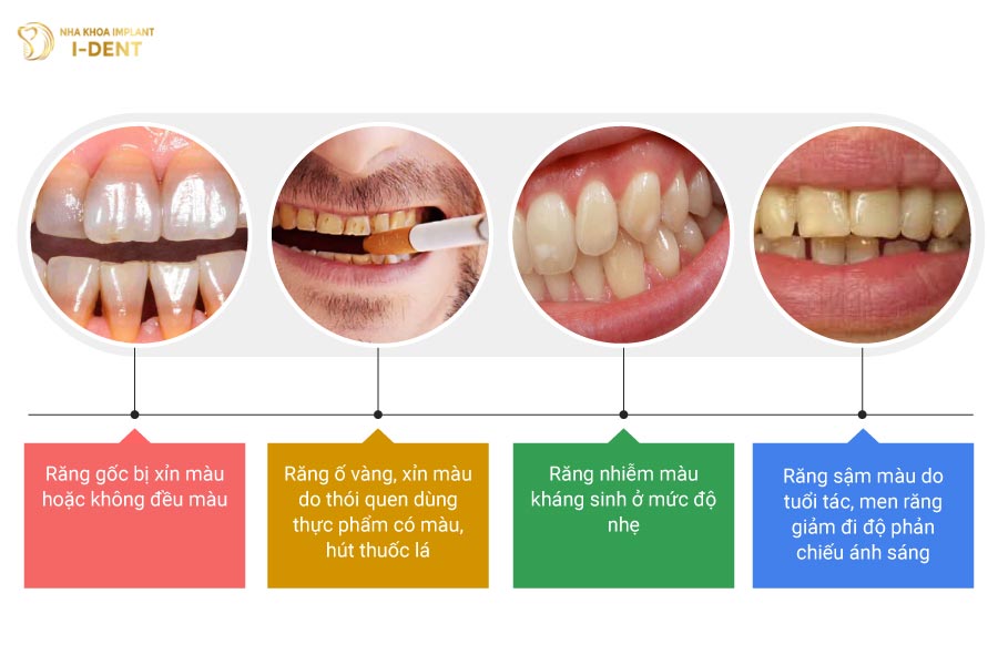 Những trường hợp nên tẩy trắng răng, để đảm bảo thẩm mỹ khuôn mặt