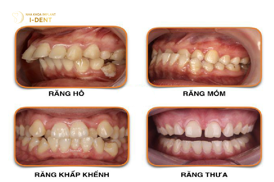 Hình ảnh các trường hợp răng thưa, hô, móm nhẹ