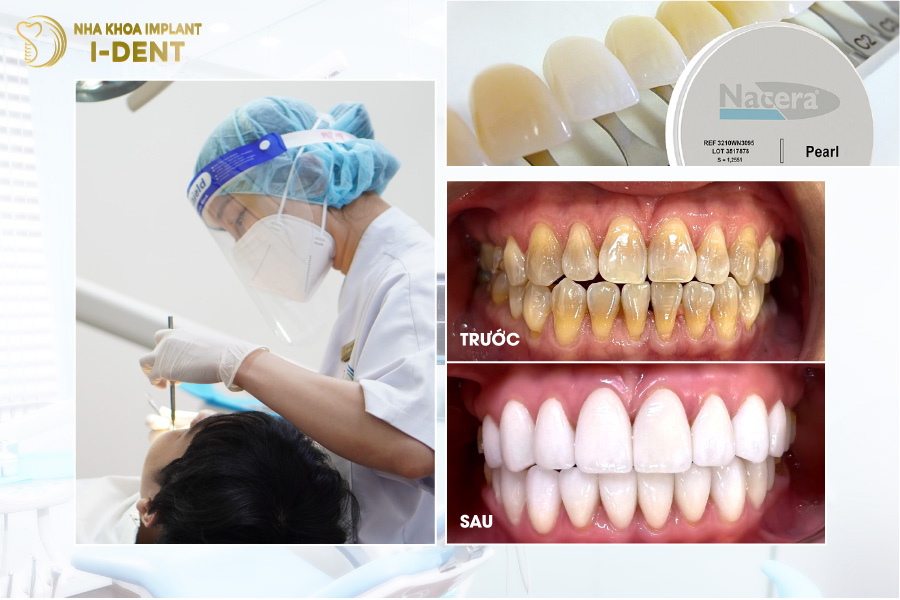 Hình ảnh răng toàn sứ Nacera 9 Max độc quyền tại nha khoa I-DENT