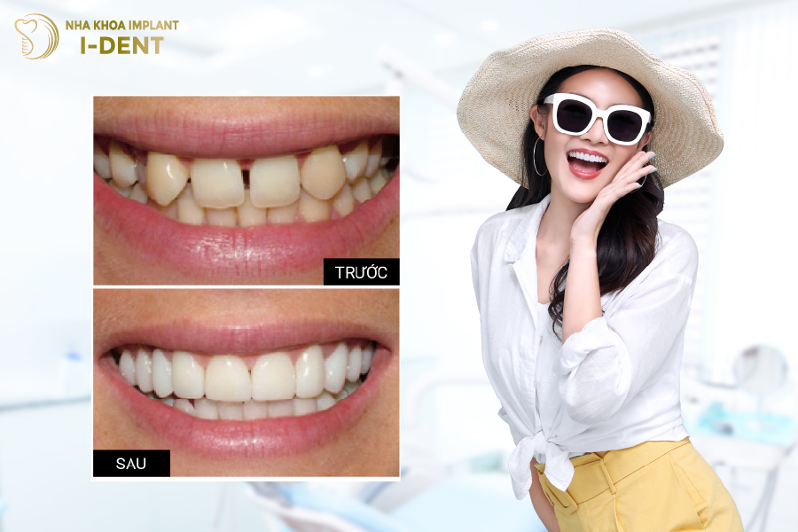 Hình ảnh trước - sau của khách hàng dán sứ tại I-DENT